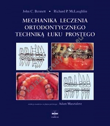 Mechanika leczenia ortodontycznego techniką łuku prostego